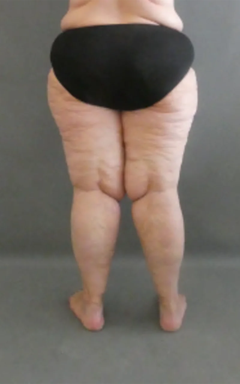 Person in schwarzer Unterwäsche vor grauem Hintergrund, zeigt Beine mit Textur, möglicherweise Lipödem oder natürliche Hautfalten.