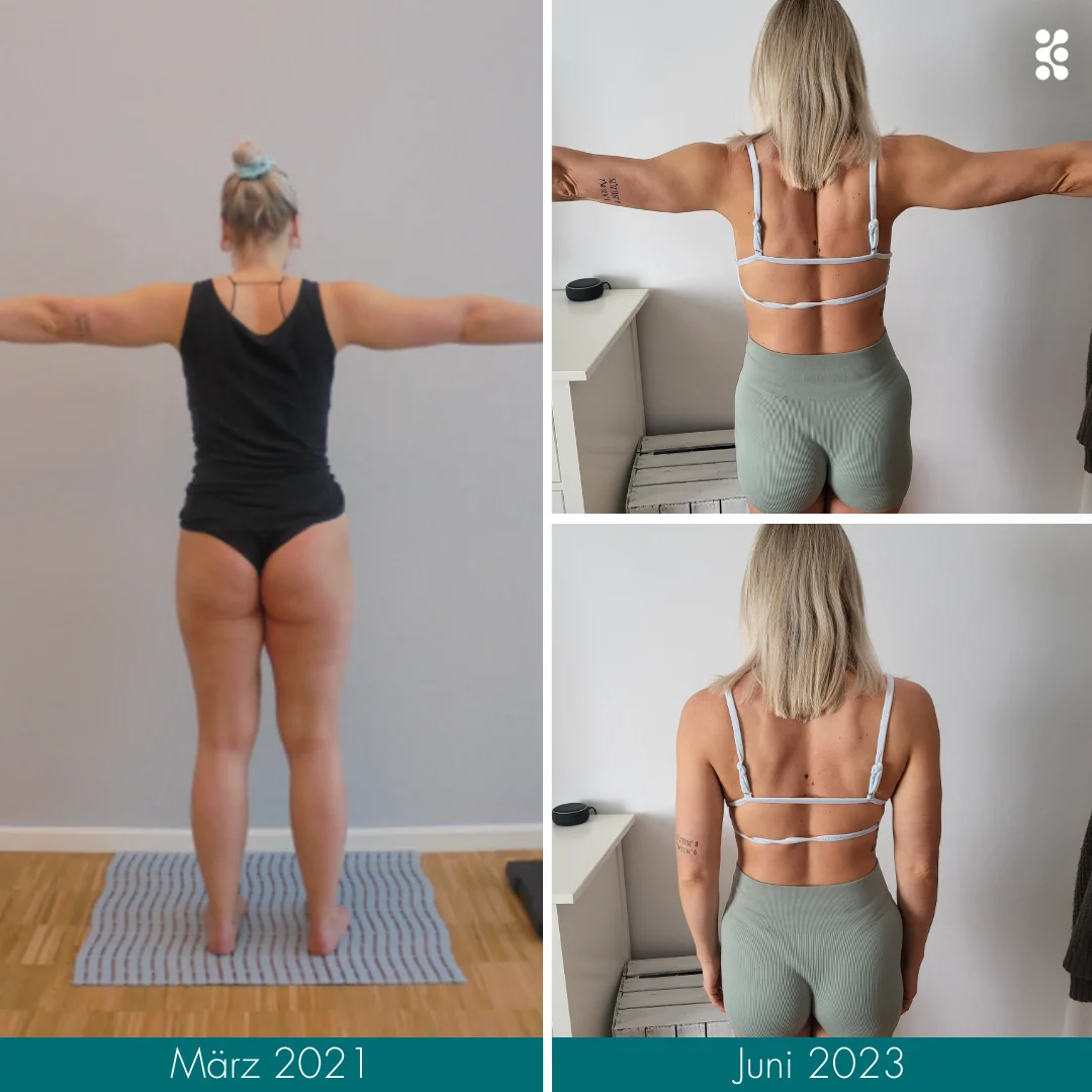 Patientin vor und nach der OP