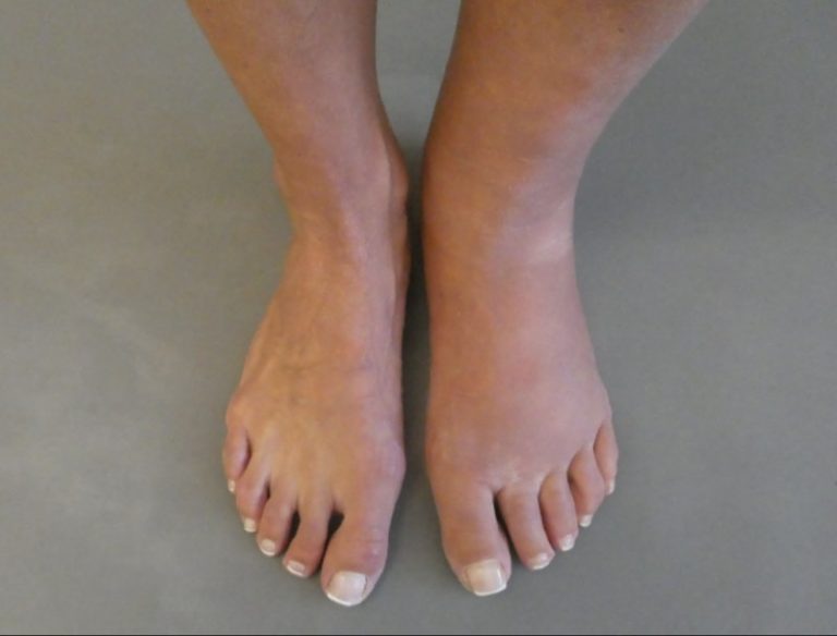Fuß und Waden einer Patientin mit Lymphödem