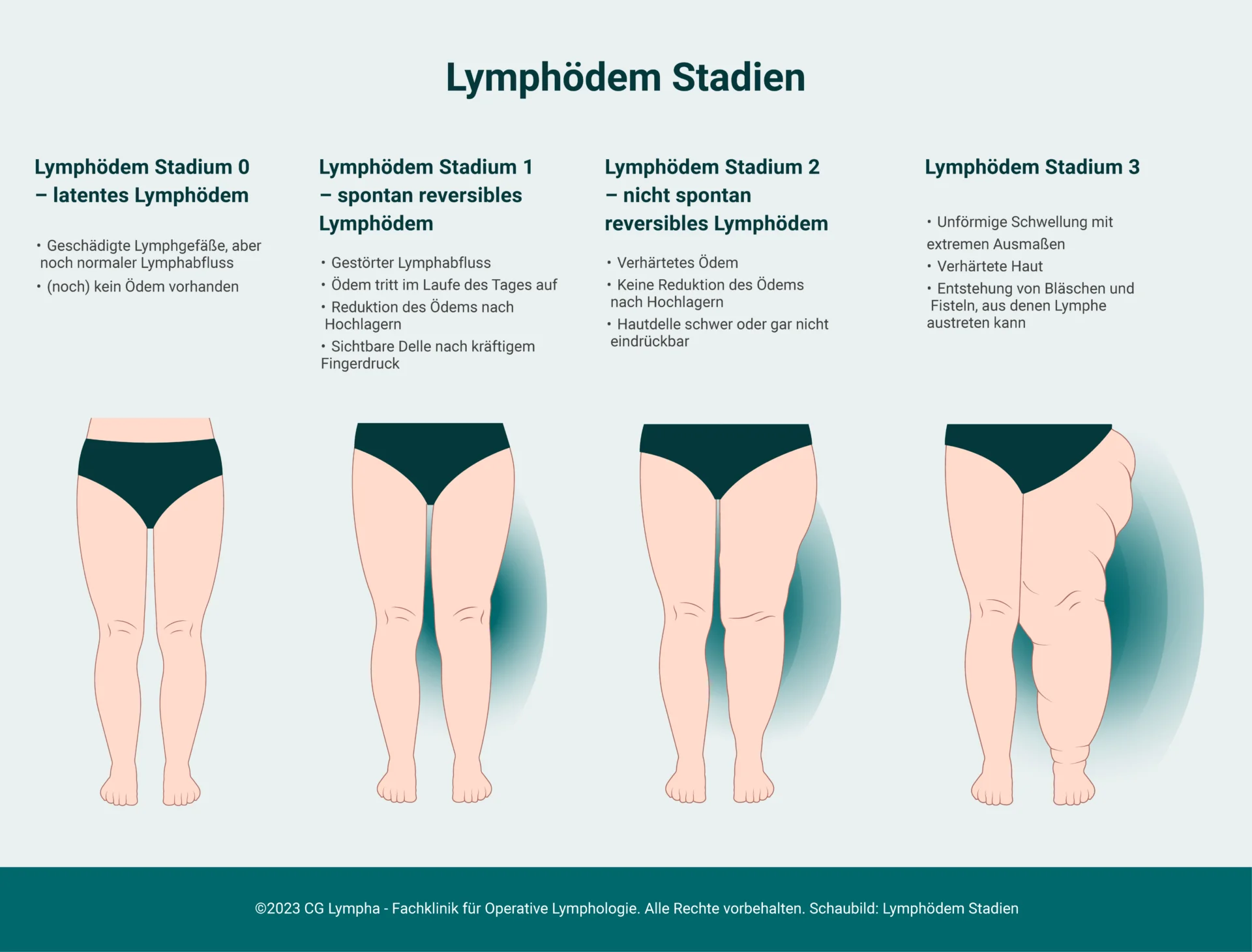 Lymphdem Stadium 3 | CG Lympha
