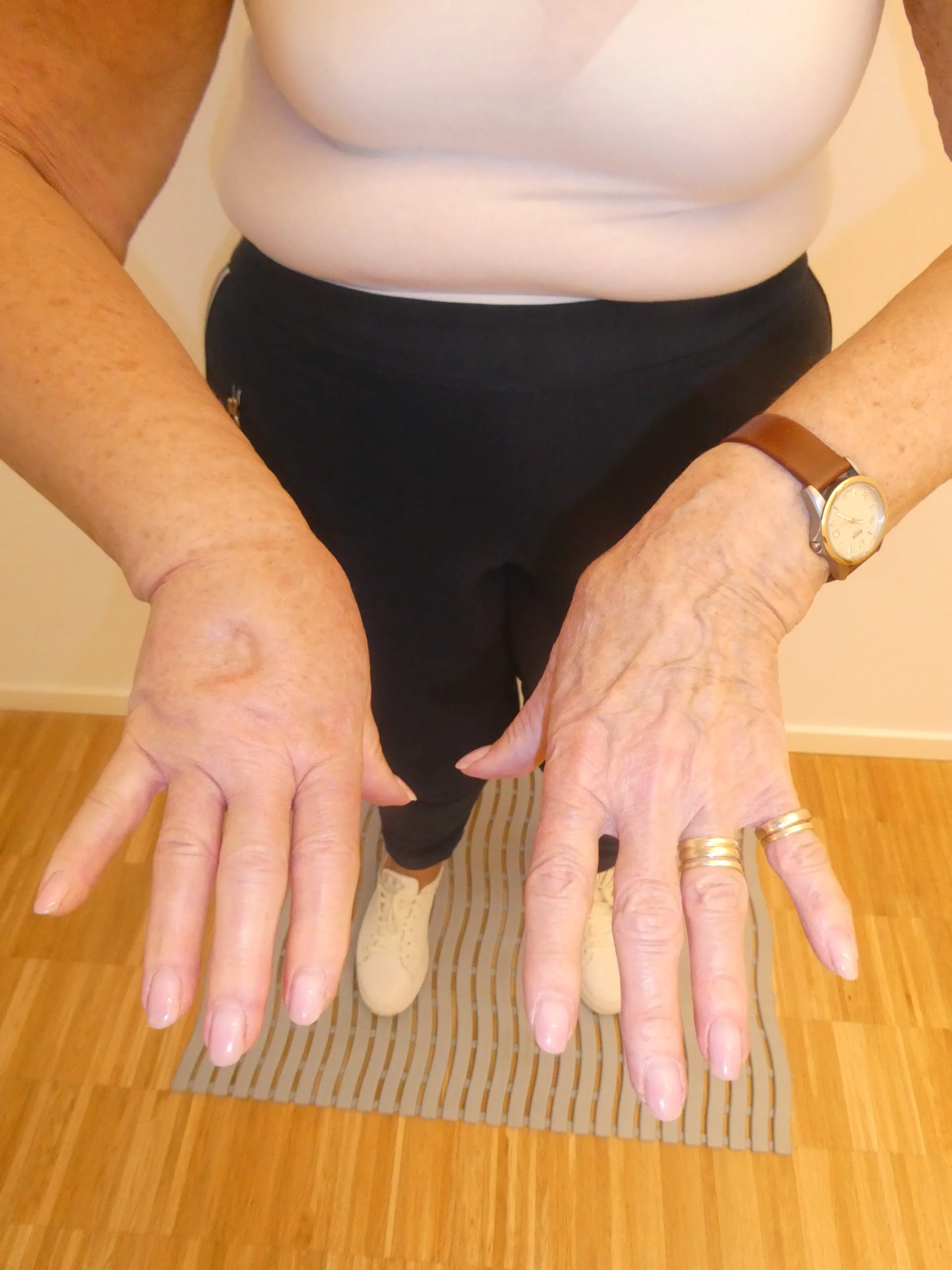 Patientin mit Lymphödem am Arm