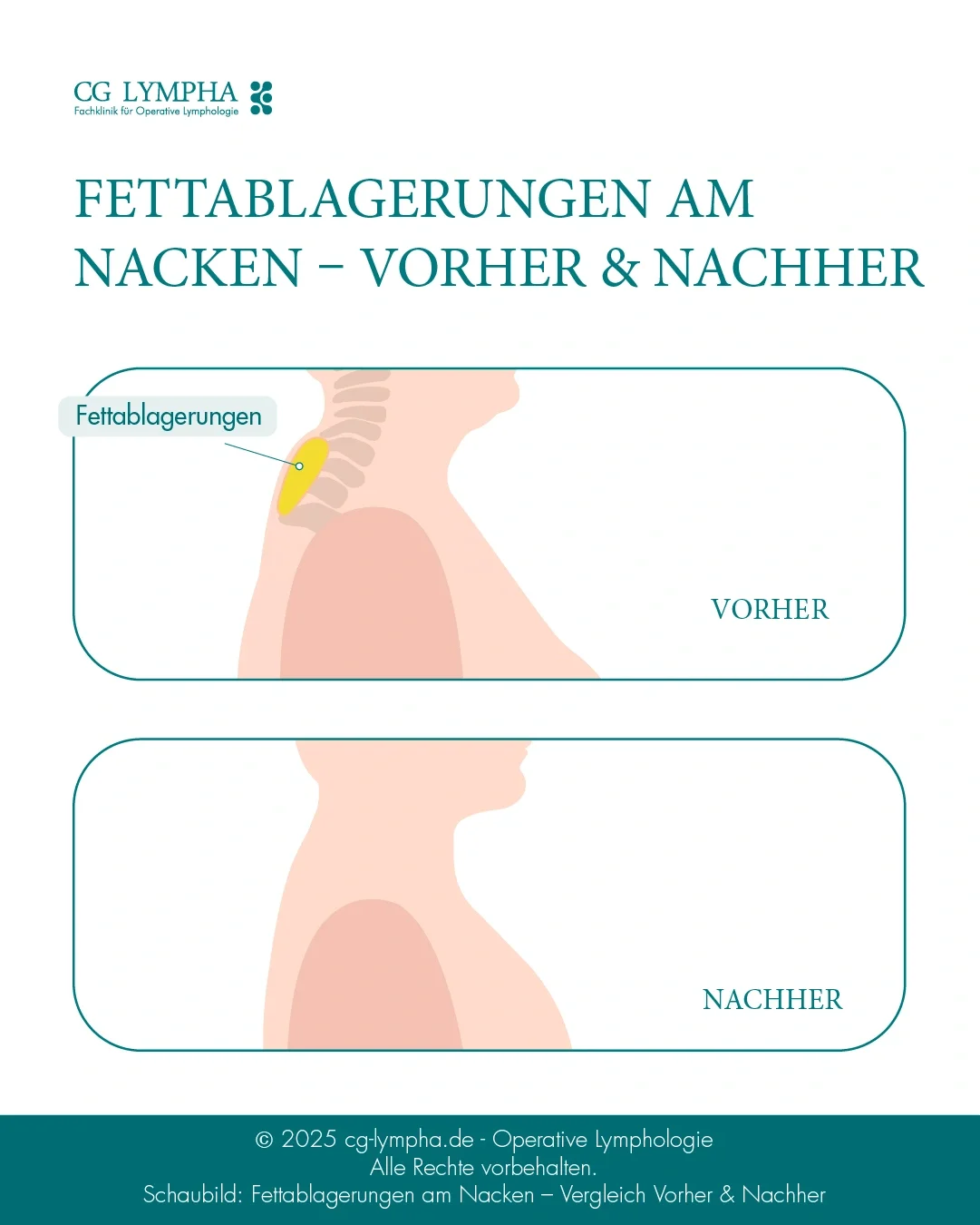 Fettabsaugung am Nacken | CG LYMPHA Fettabsaugung am Nacken | CG LYMPHA